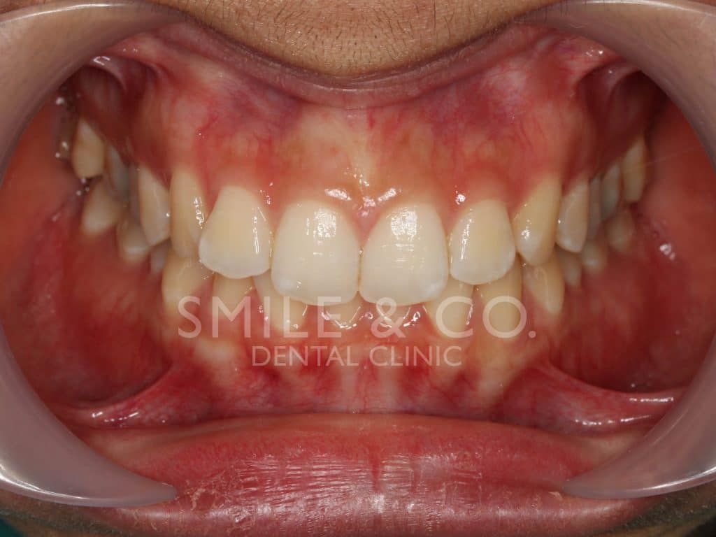 รีวิวจัดฟันแบบใส invisalign ภายในช่องปาก