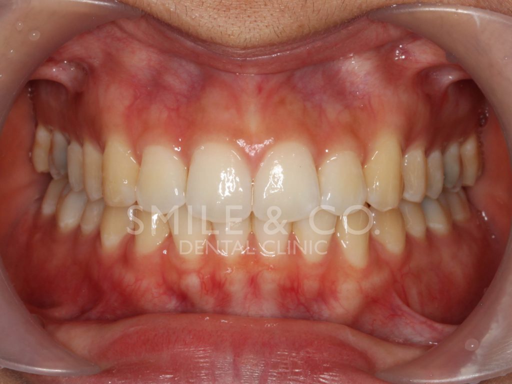รีวิว-หลังจัดฟันแบบใส-invisalign-ภายในช่องปาก