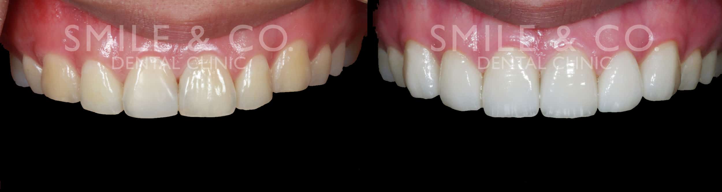 veneer_case