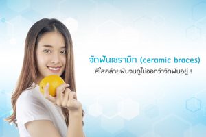 จัดฟันเซรามิก