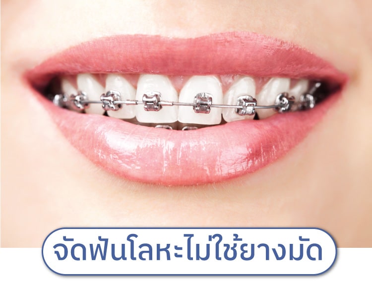 จัดฟันแบบดามอน-ไม่ใช้ยางมัด