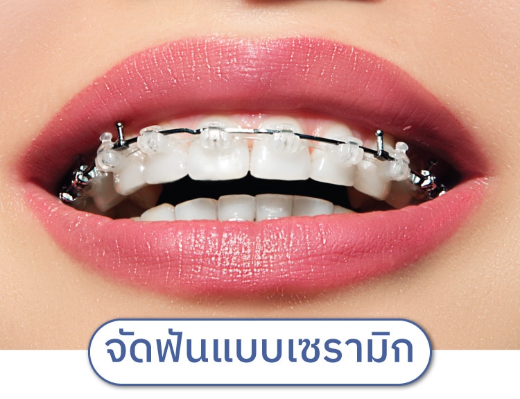 จัดฟันแบบเซรามิก