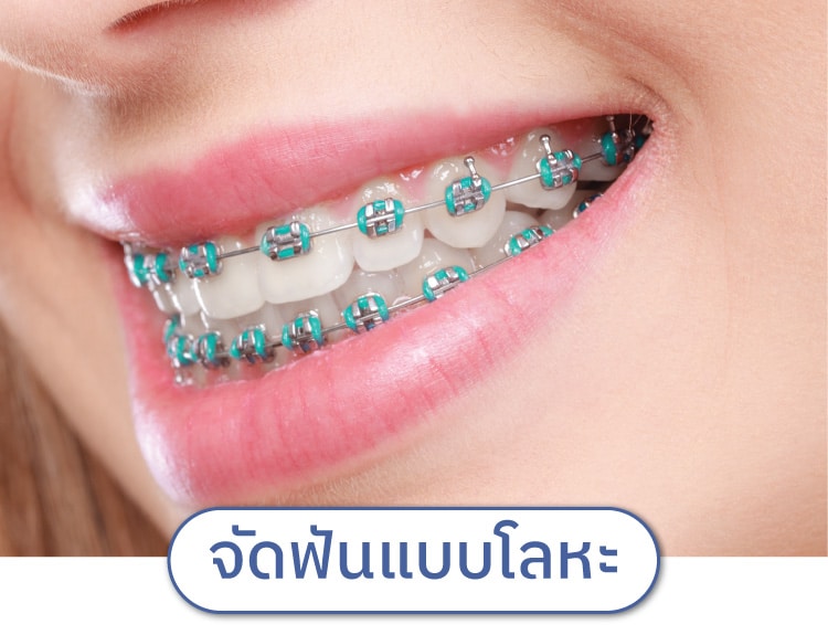 จัดฟันแบบโลหะ