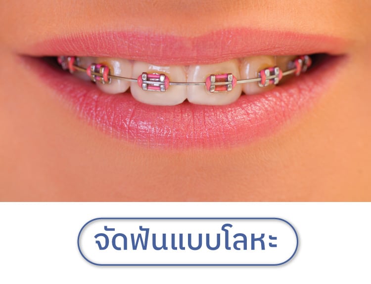 จัดฟันแบบโลหะ คืออะไร