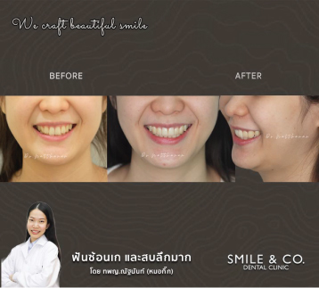 จัดฟันแบบโลหะ-แก้ปัญหา-ฟันซ้อนเก-และสบลึกมาก