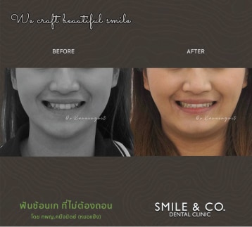 จัดฟันแบบโลหะ-แก้ปัญหา-ฟันซ้อนเก-ไม่ถอนฟัน