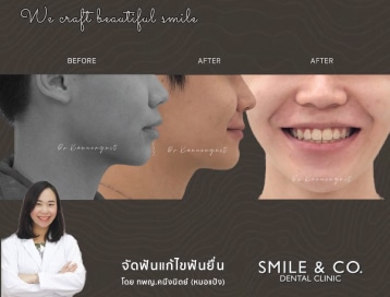 จัดฟันแบบโลหะ-แก้ไขปัญหาฟันยื่น