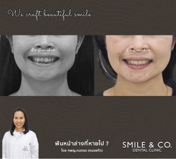 จัดฟันแบบโลหะ-แก้ไขฟันหน้าล่างที่หายไป