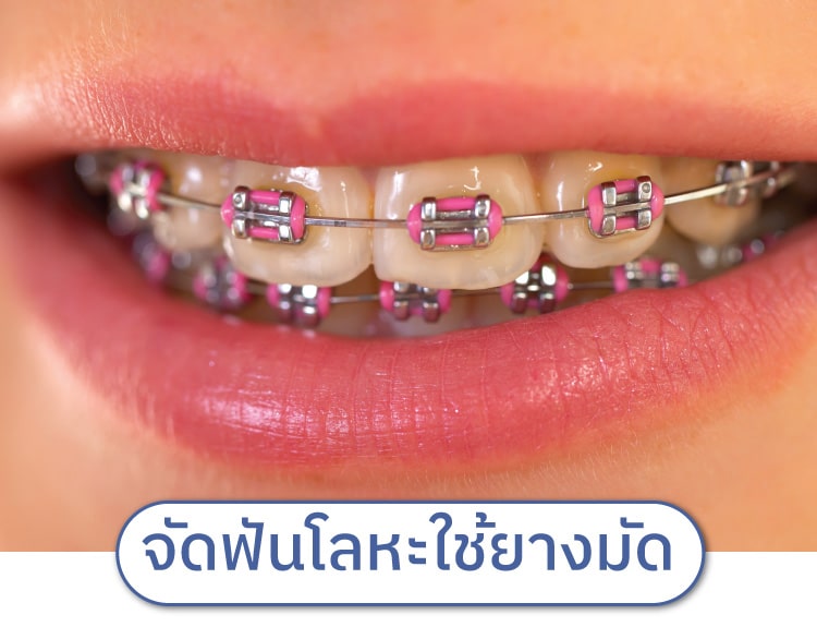 จัดฟันแบบโลหะ-ใช้ยางมัด