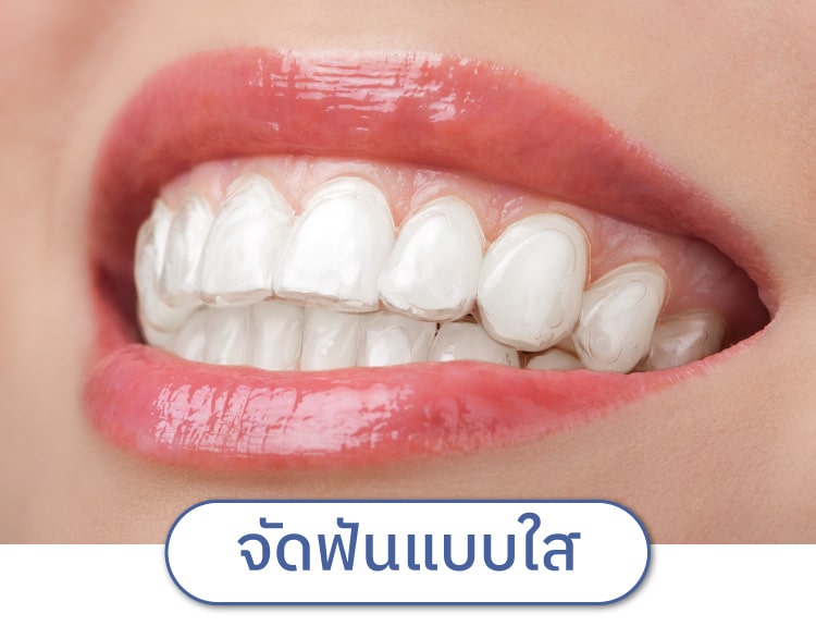 จัดฟันแบบใส