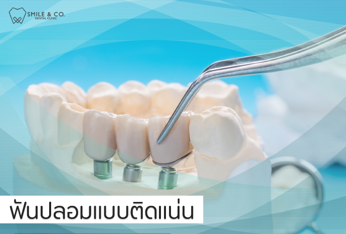 ฟันปลอมแบบติดแน่น