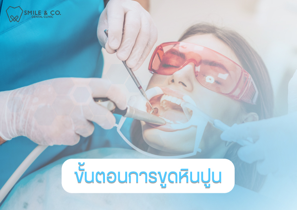 ขั้นตอนการขูดหินปูน