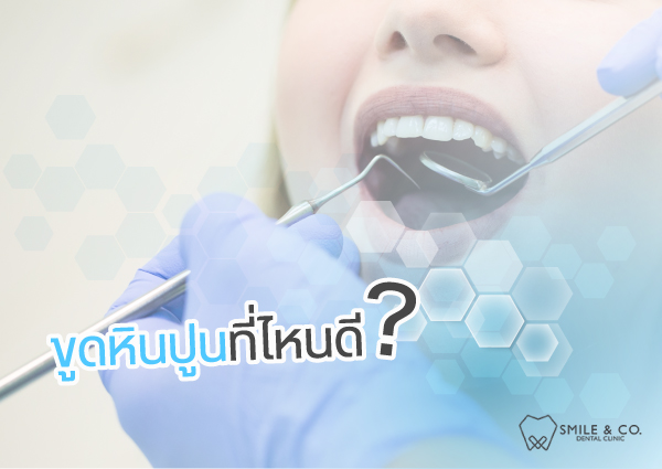 ขูดหินปูนที่ไหนดี