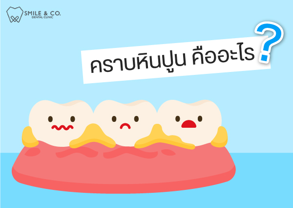 คราบหินปูน-คืออะไร