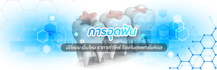 การอุดฟัน-มีกี่แบบ-เจ็บไหม-ราคาเท่าไหร่-cover-post