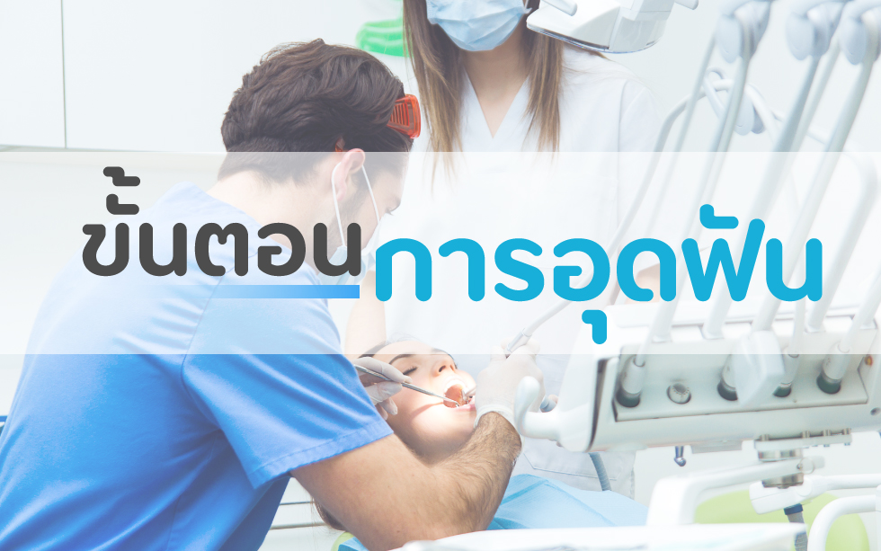 ขั้นตอนการอุดฟัน
