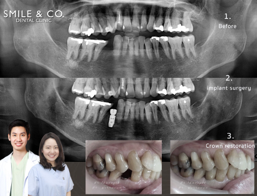 เคสการทำรากฟันเทียม-AstraTech-และครอบฟัน-zirconia