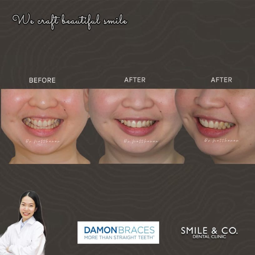 รีวิวจัดฟัน-damon-braces