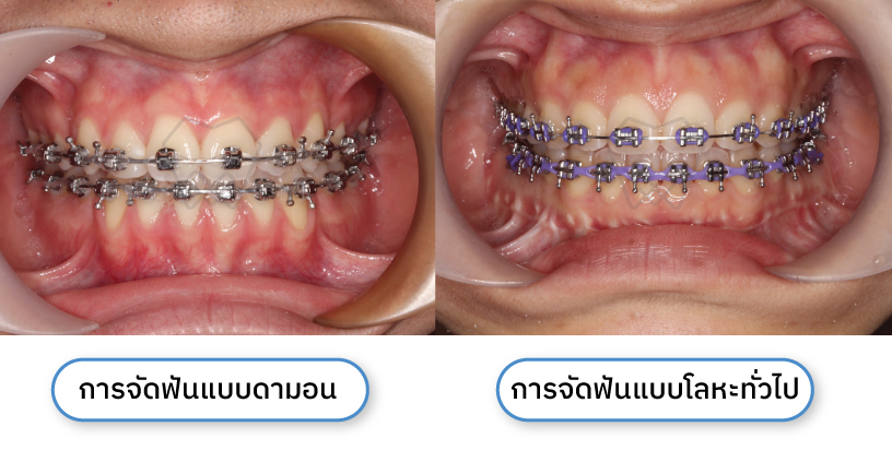 จัดฟันแบบดามอน-แตกต่างกับการจัดฟันแบบอื่น-อย่างไร