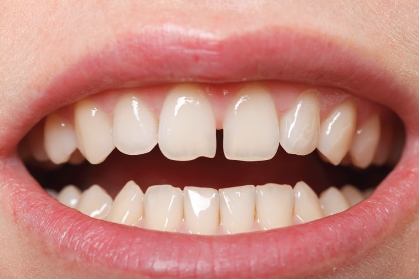 ปัญหาการเรียงตัวของฟัน-เกิดจากอะไร