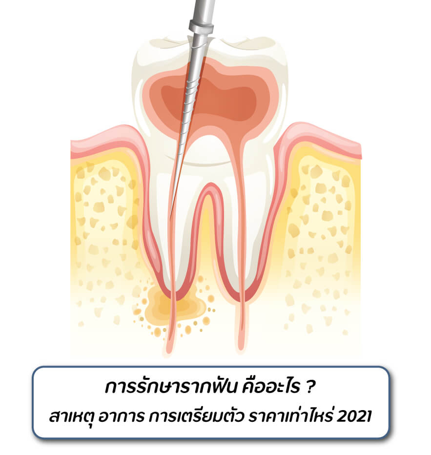 การรักษารากฟัน คืออะไร สาเหตุ อาการ วิธีการรักษา ราคาเท่าไหร่ 2023