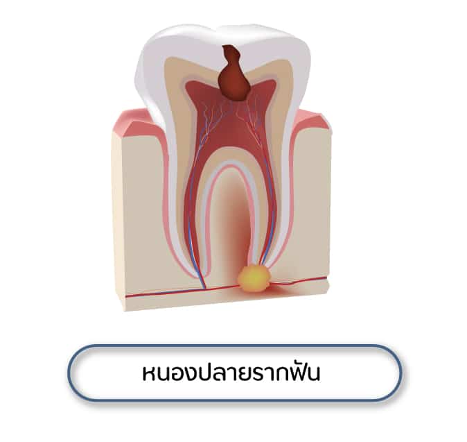 การรักษารากฟัน คืออะไร สาเหตุ อาการ วิธีการรักษา ราคาเท่าไหร่ 2023