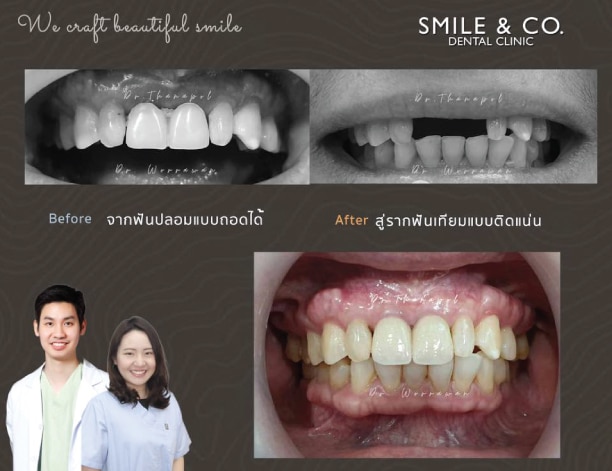 case dental implant-30-07-2020