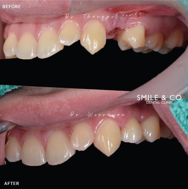 case dental implant hiossen 28-02-2022