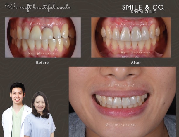 crown ceramic-veneer-implant dental-04-05-2020
