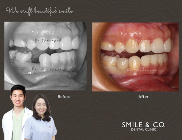 dental implant-16-07-2020