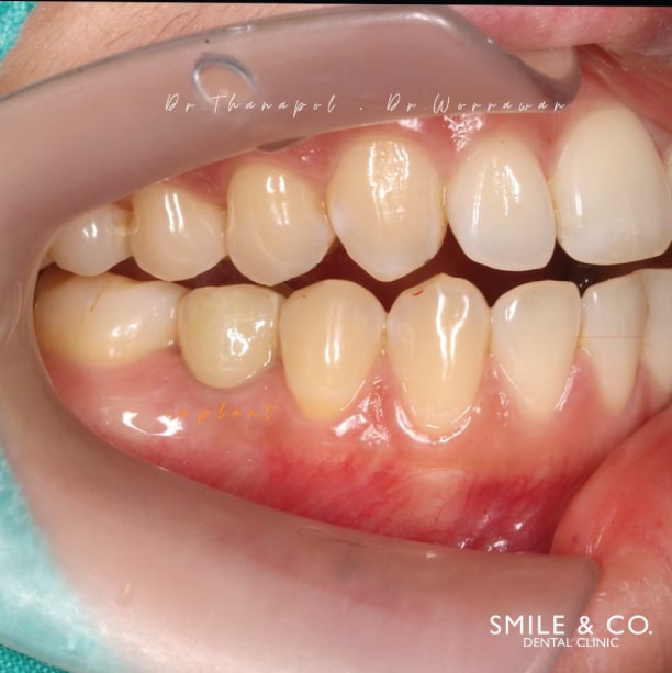 dental implant strauman 23-06-2021