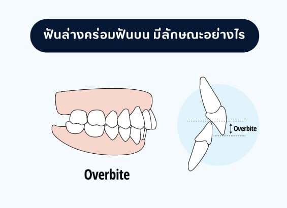 ฟันล่างคร่อมฟันบน-มีลักษณะอย่างไร