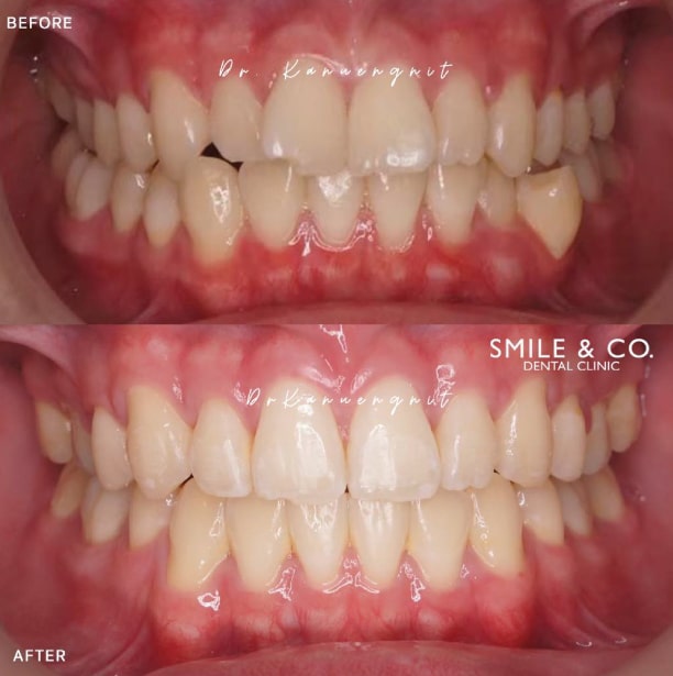 Invisalign Before and After-05