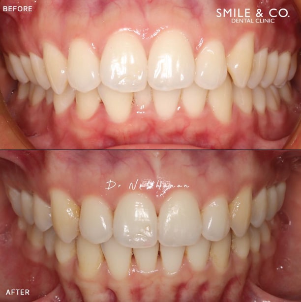 Invisalign Before and After-07