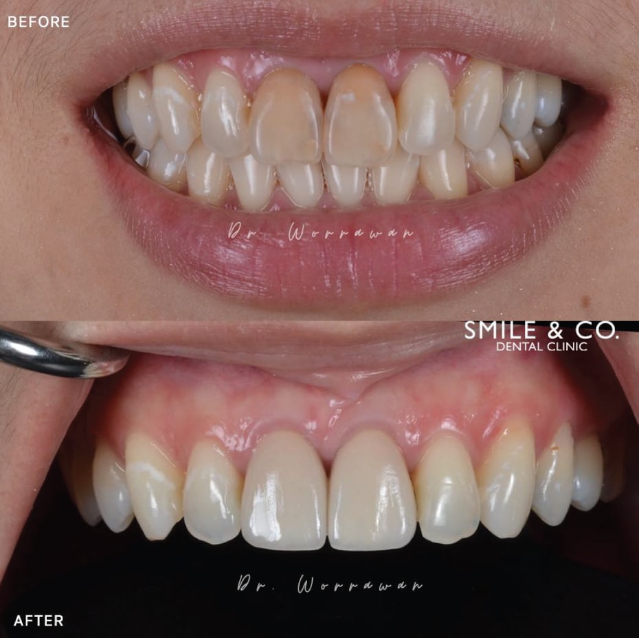 dental crowns before and after-01