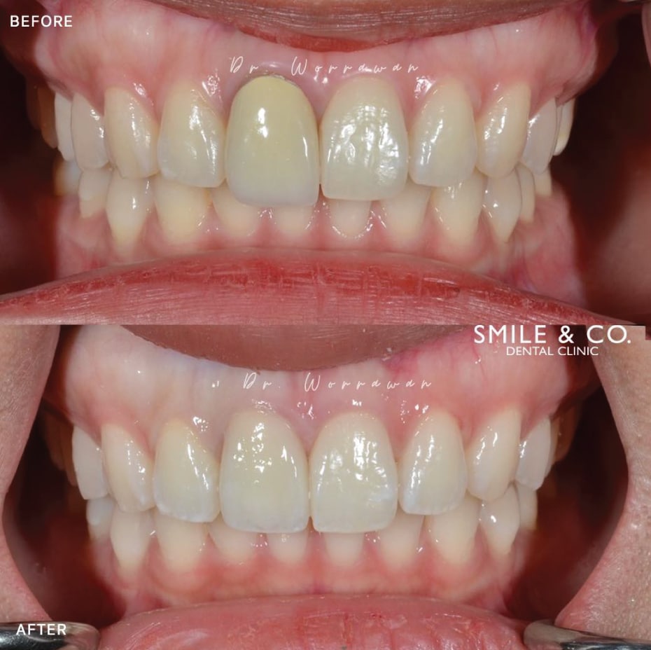 dental crowns before and after-02