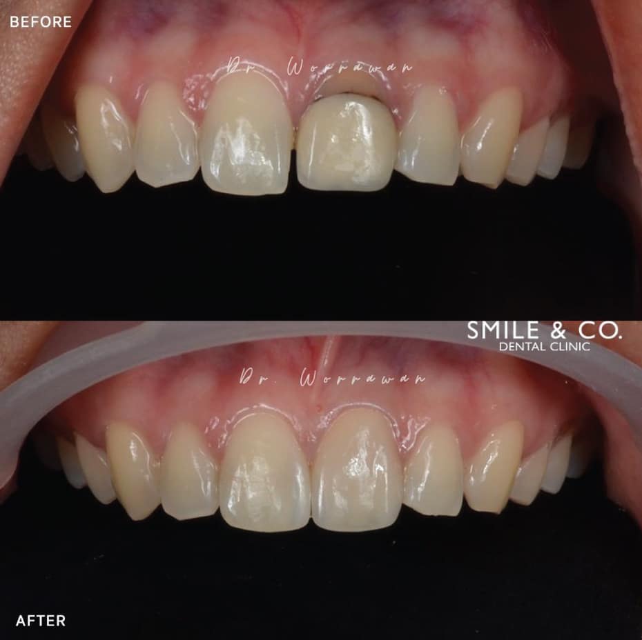 dental crowns before and after-03