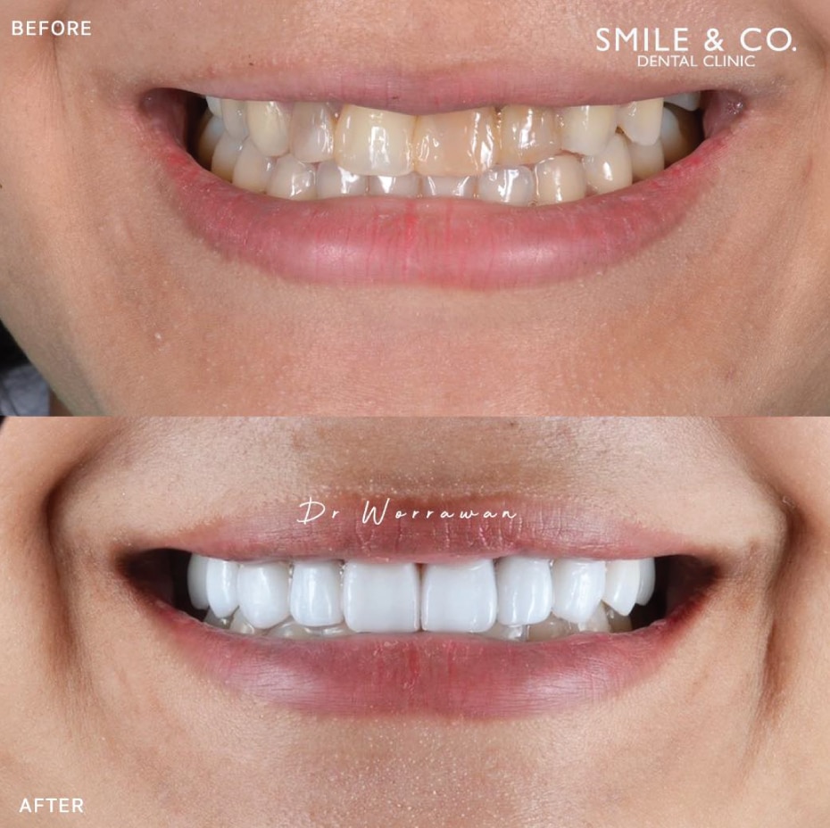 dental crowns before and after-04