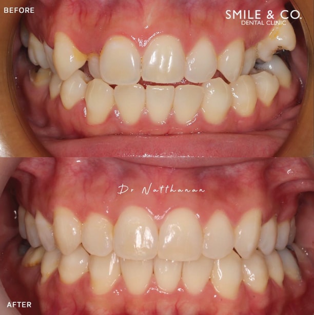 invisalign-before-and-after-01