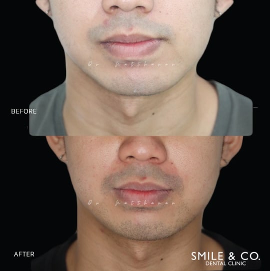 jaw surgery before and after-02