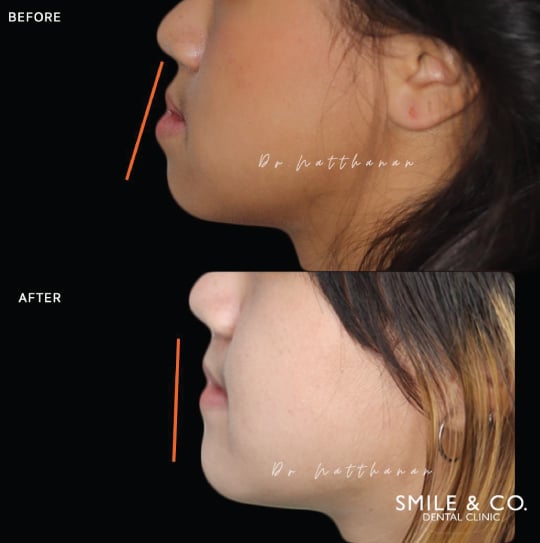 jaw surgery before and after-03