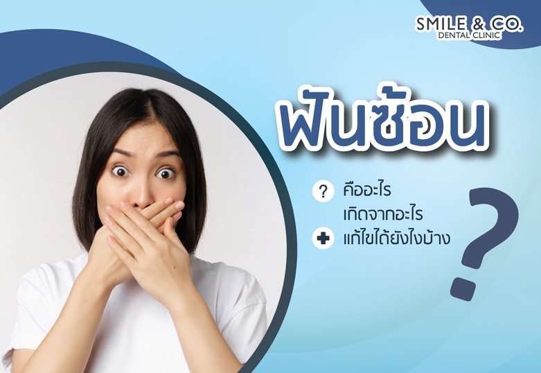 ฟันซ้อน คืออะไร เกิดจากอะไร แก้ไขได้ยังไงบ้าง ทันตแพทย์มีคำตอบ