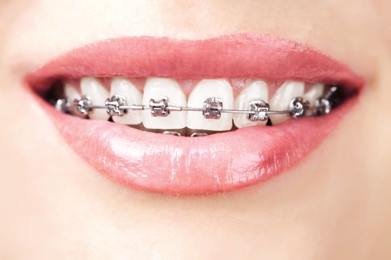 Damon System Braces