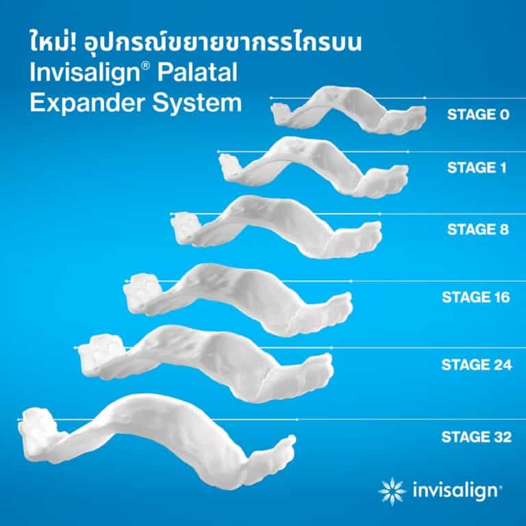 Invisalign Palatal Expander ขยายขากรรไกรเด็ก แบบไม่เจ็บ