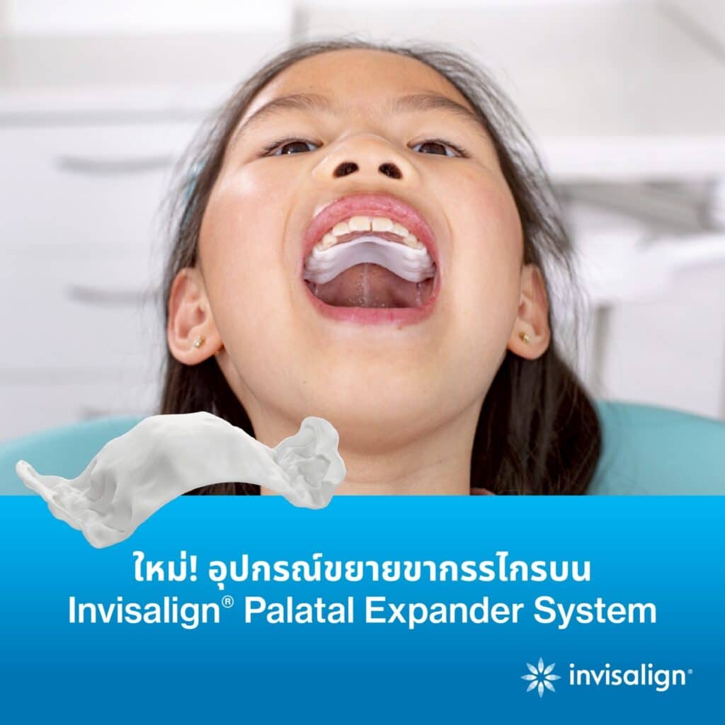 Invisalign Palatal Expander System for kids
