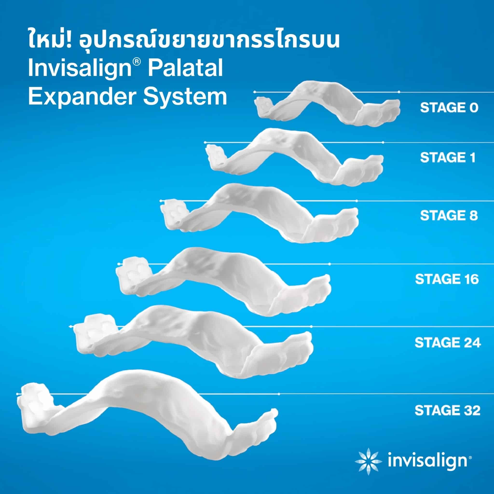 Invisalign Palatal Expander ขยายขากรรไกรเด็ก แบบไม่เจ็บ