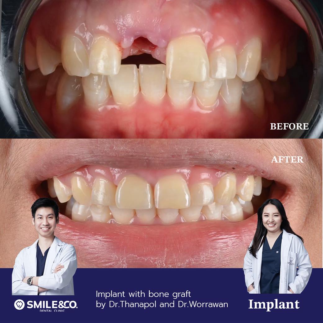 case review implant 01