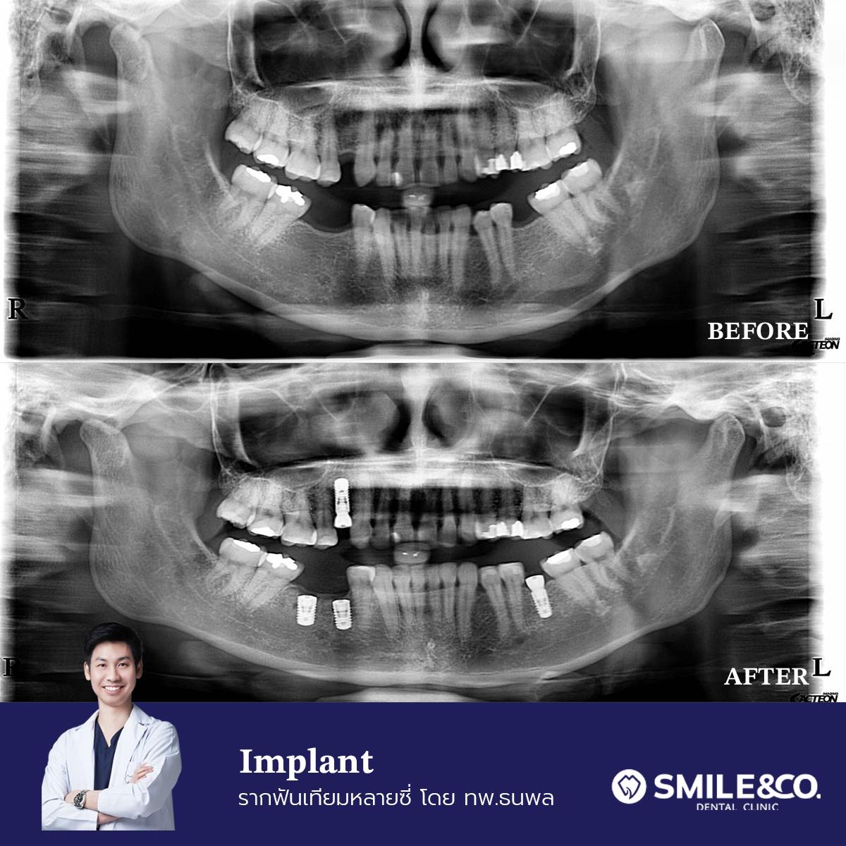 case review implant 02