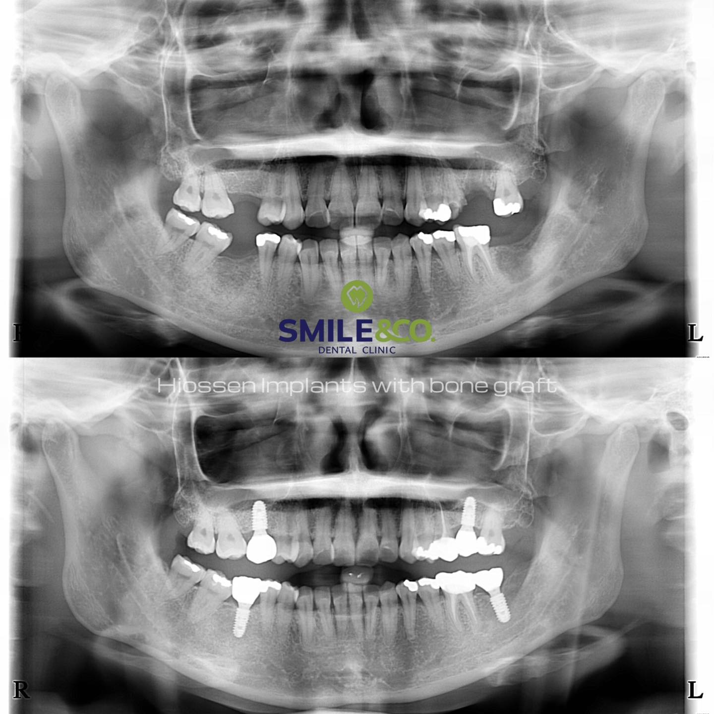 case review implant 03