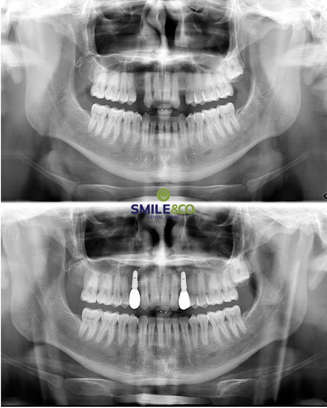 case review implant 04
